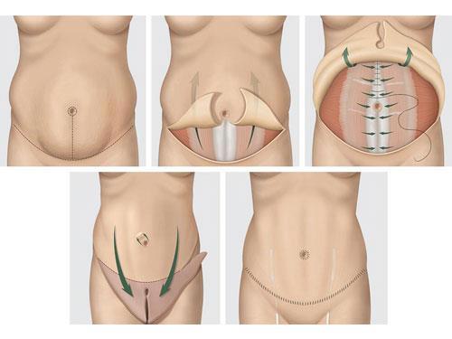 Suites opératoires d'une abdominoplastie : tout savoir